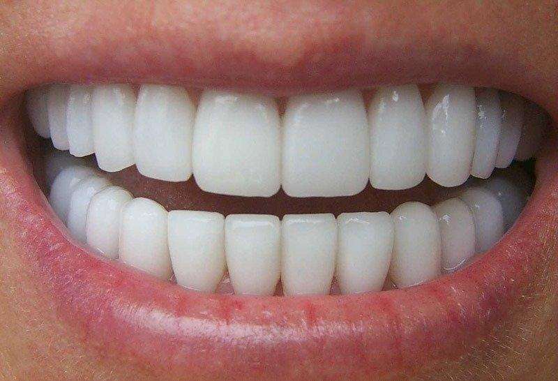 Facetas dentárias e estética do sorriso em Curitiba - Dr. Rullian Pinheiro